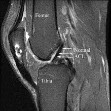 Normal ACL on MRI scan