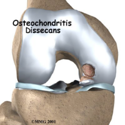 OCD lesion causing cartilage defect