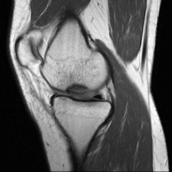 MRI showing osteochondritis dessicans lesion