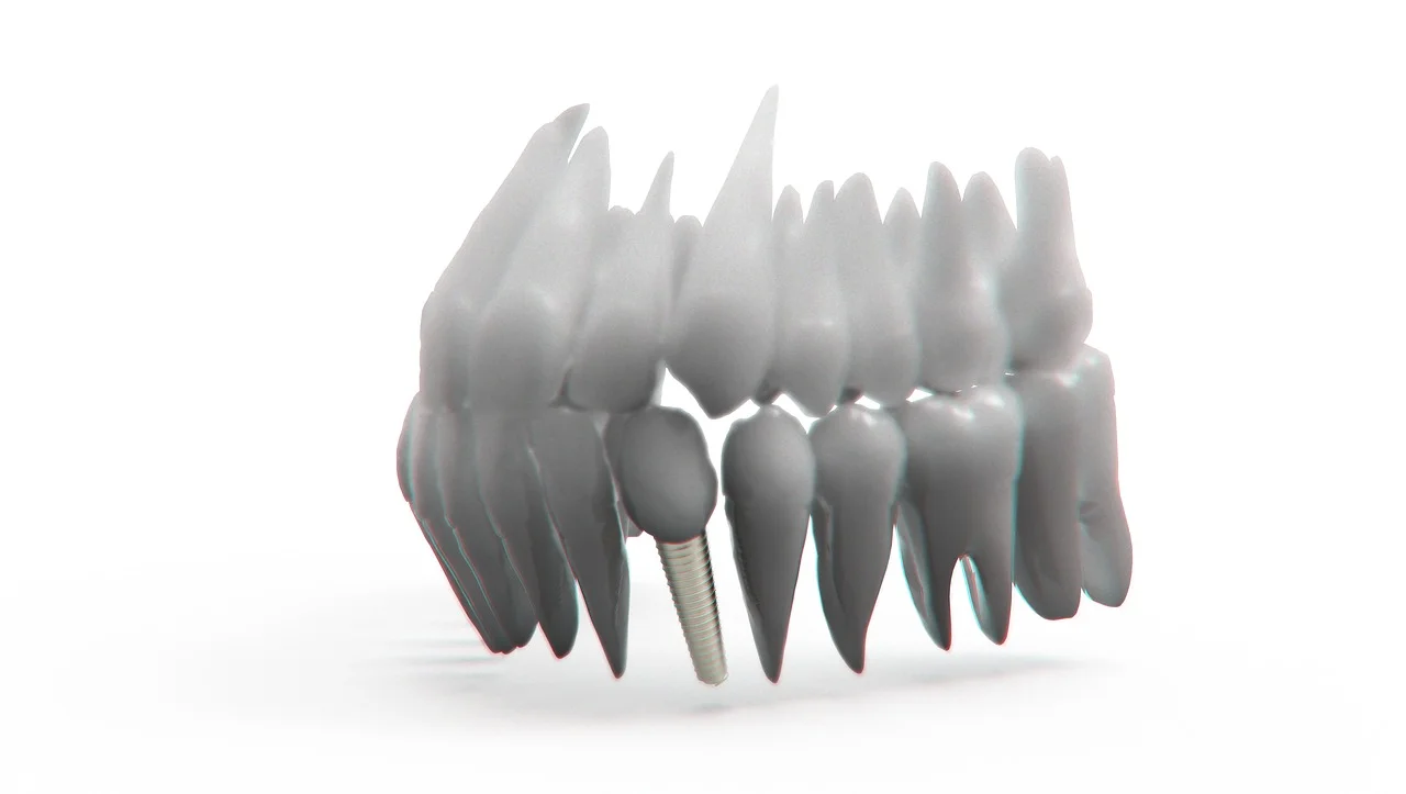 The Difference Between Dental Crowns and Dental Implants