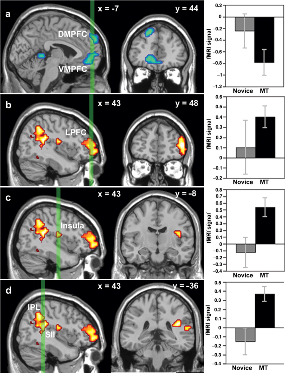 fMRI scans reveal changes in the brain after only eight weeks of mindfulness and emotional intelligence training