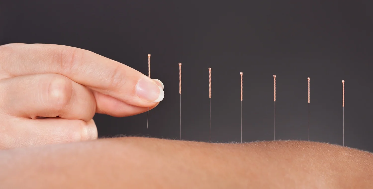Acupuncture - Cupping.jpg