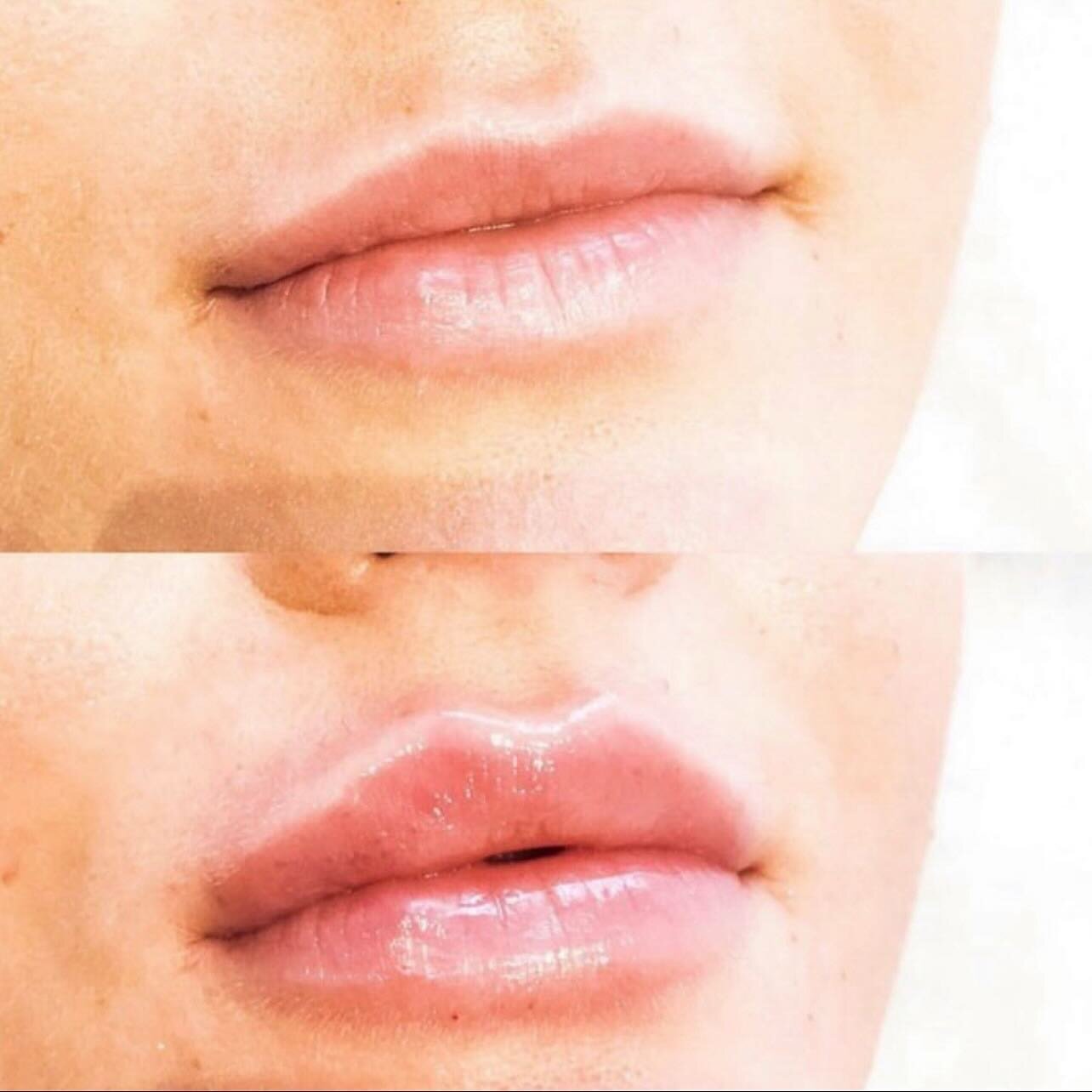 Natural-looking lip filler is best because it provides a subtle enhancement that complements your features, avoids exaggerated results, and ages gracefully over time. It ensures a refreshed appearance without looking overly artificial, contributing t