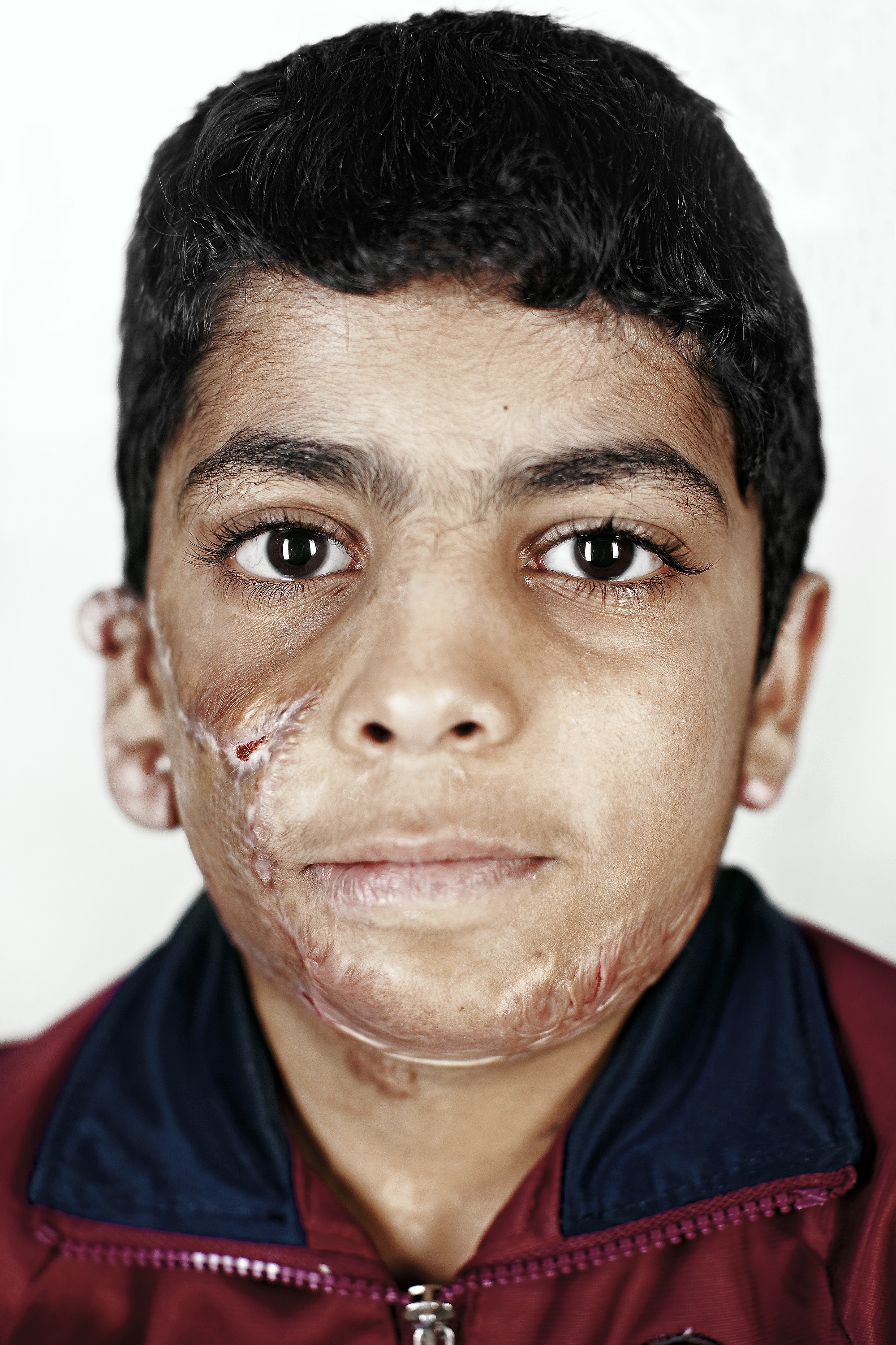  Hussein Talib, from Mosul, is nine years old. He has been in Amman for a year and three months. A bomb went off when he was inside his home, killing his mother and leaving him with severe wounds.&nbsp; 