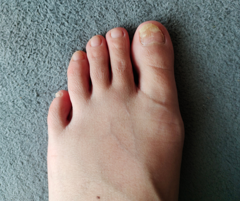 “Is My Ingrown Toenail Infected?” — The Foot & Ankle Center Of Maryland