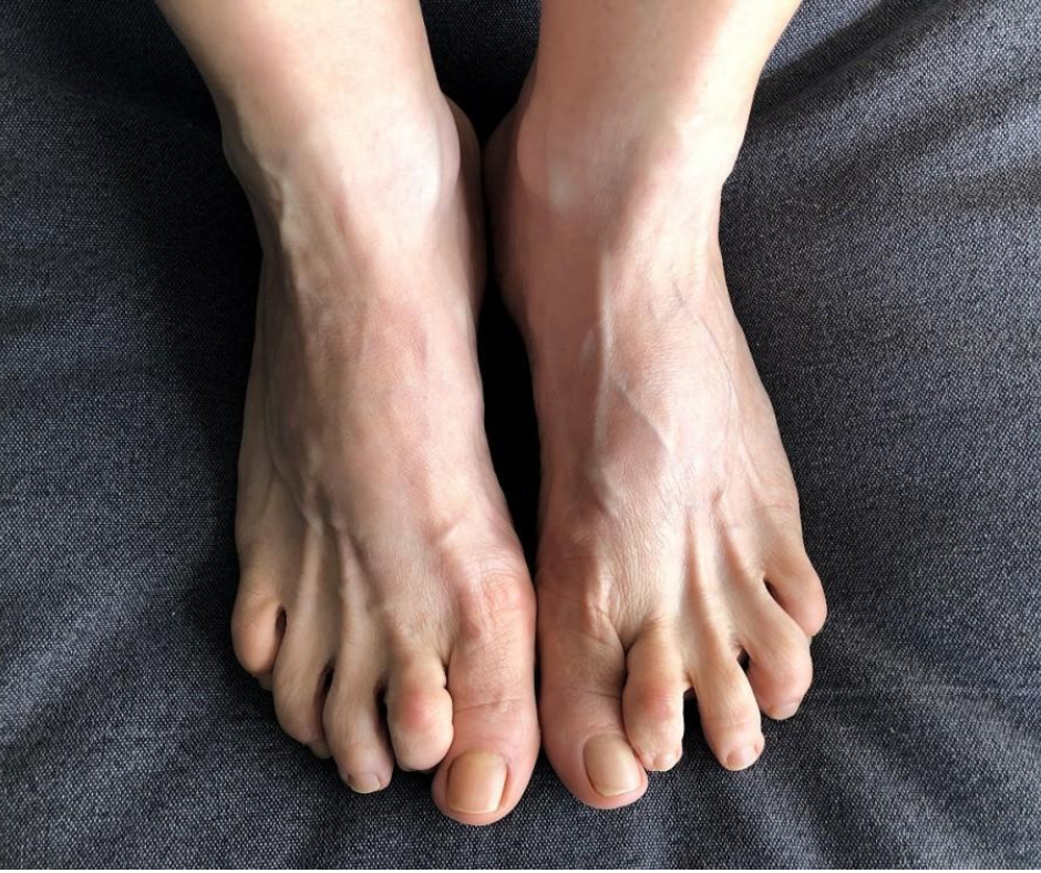 Flexible vs. Rigid: How to Stop Your Hammertoe from Getting Worse