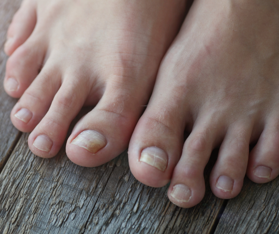 What Can Brittle Toenails Tell You About Your Heart?