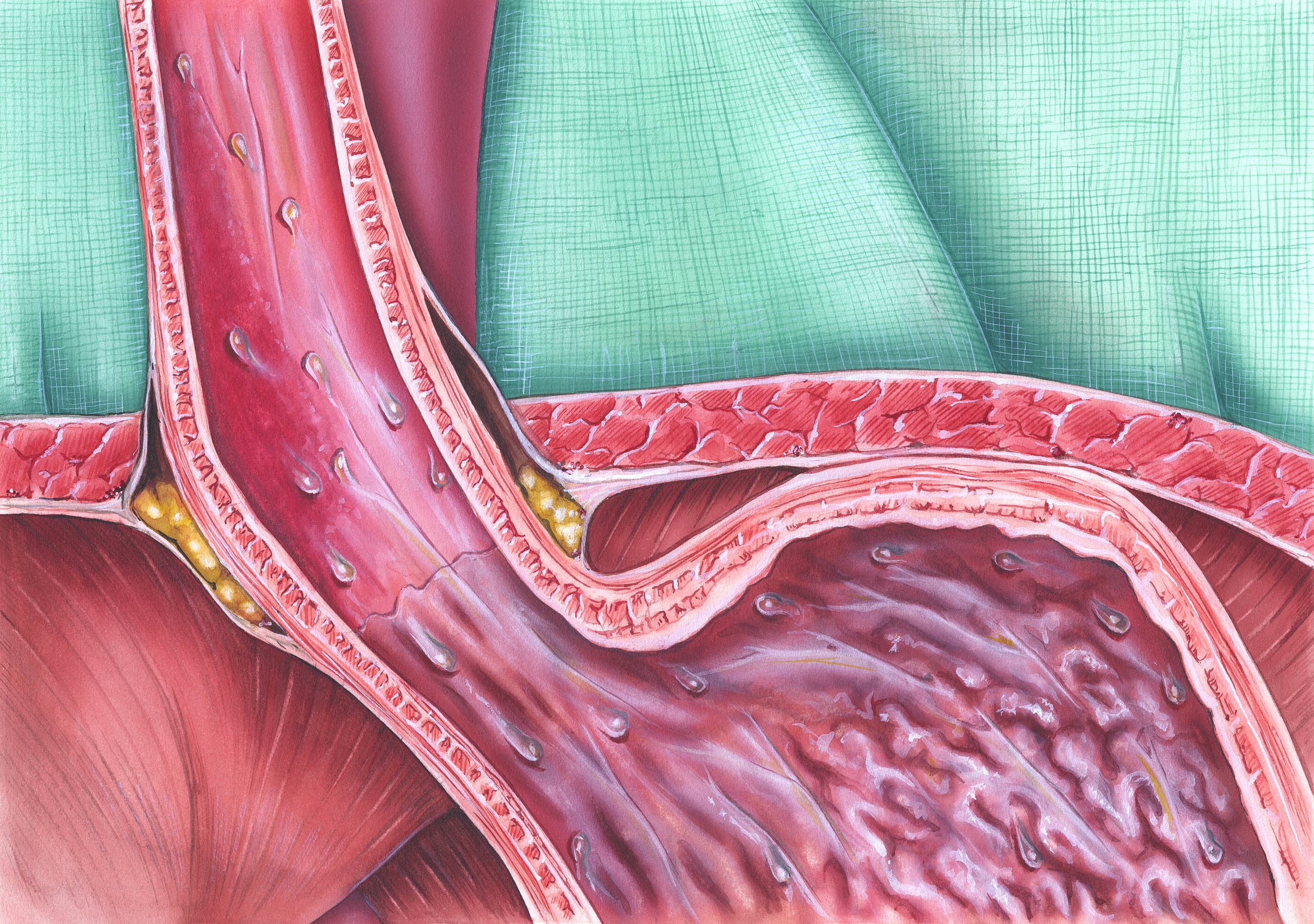 Заброс из желудка в пищевод и горло. Эозинофильный эзофагит эндоскопия. Рефлюкс-эзофагит (пептический эзофагит). Некротический эзофагит.