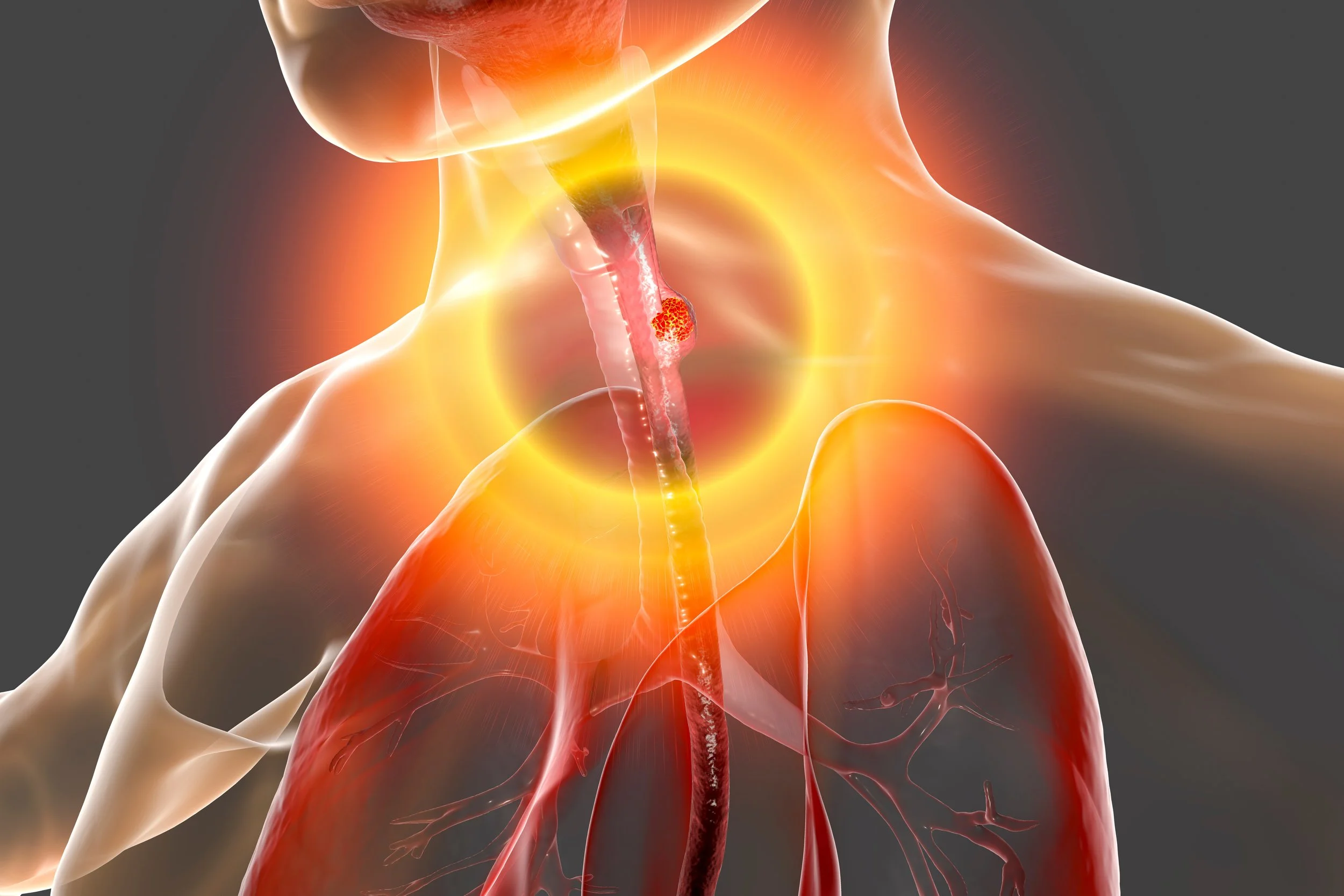 The 15 Esophageal Cancer Risk Factors