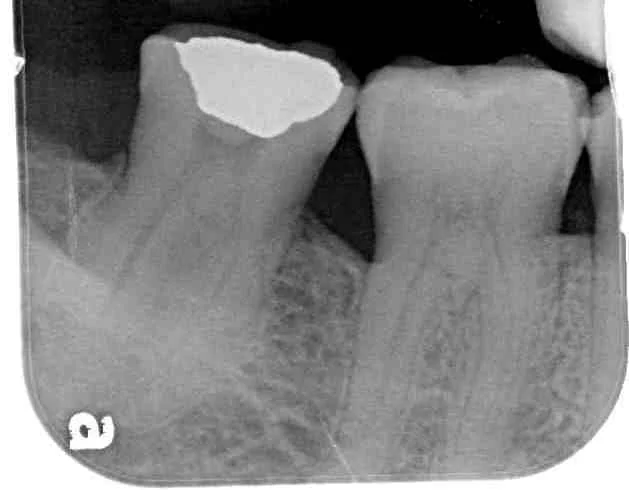Conservative Management of Intrabony Defect — Perio Centre