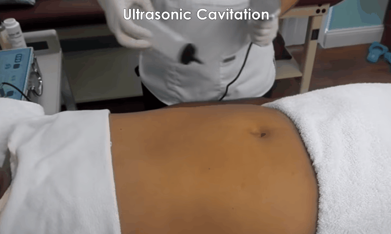 Ultrasonic Cavitation.gif