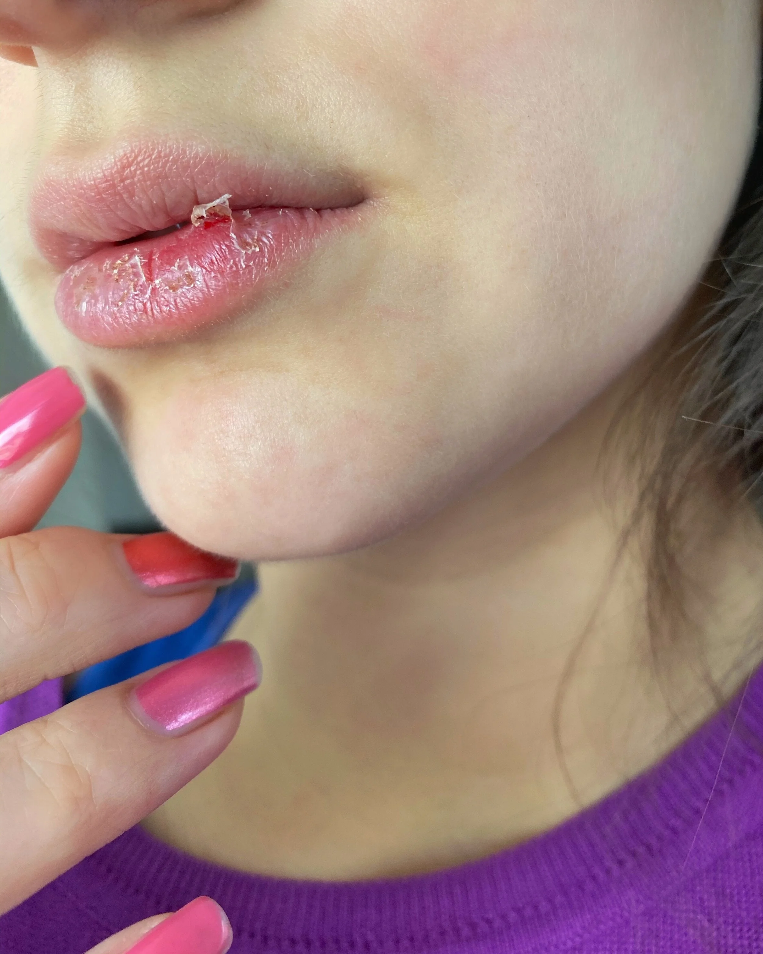 TROCKENE LIPPEN WÄHREND DER SCHWANGERSCHAFT: DIESE TIPPS UND HILFSMITTEL SOLLEN HELFEN