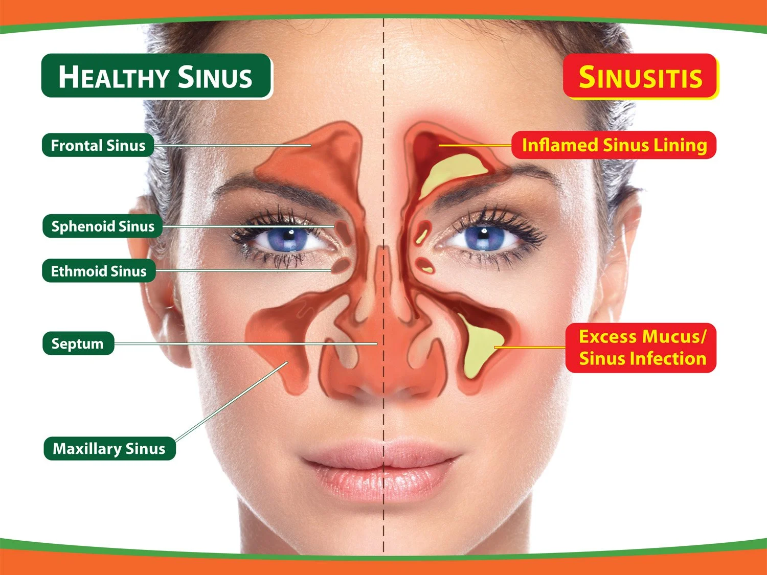 How to help reduce your risk of Sinusitis