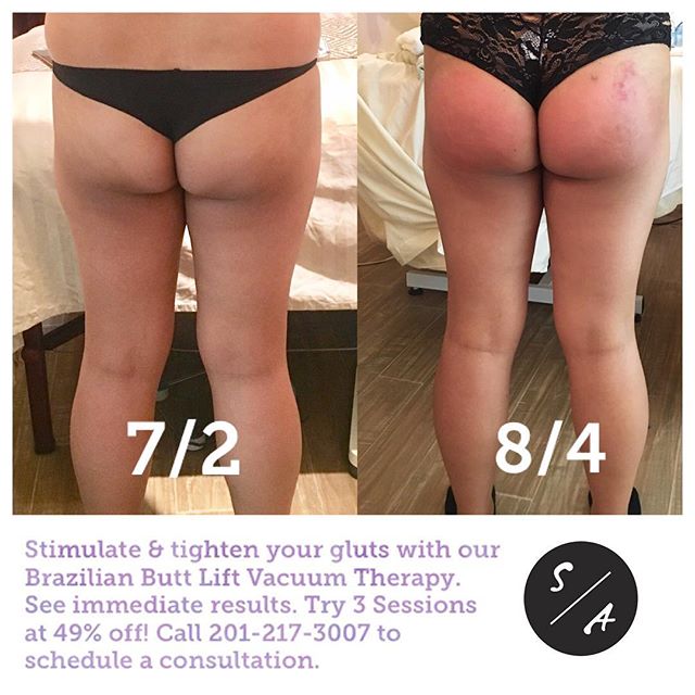 Stimulate &amp; tighten your gluts with our Brazilian Butt Lift Vacuum Therapy. See immediate results. To learn more about this service visit our website. 
Special offer for first time clients. Try 3 sessions at 49% off! 
Call 201-217-3007 to schedul