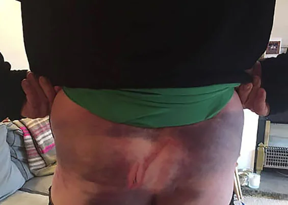 Back 1-Jeff Ellison’s Recovery-The Photobiomodulation Studio Blog-crop.jpg