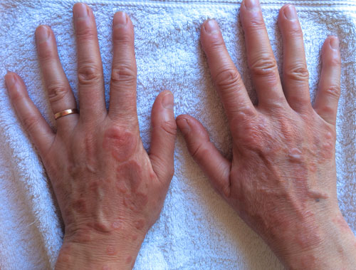 Tania’s hands before treatment
