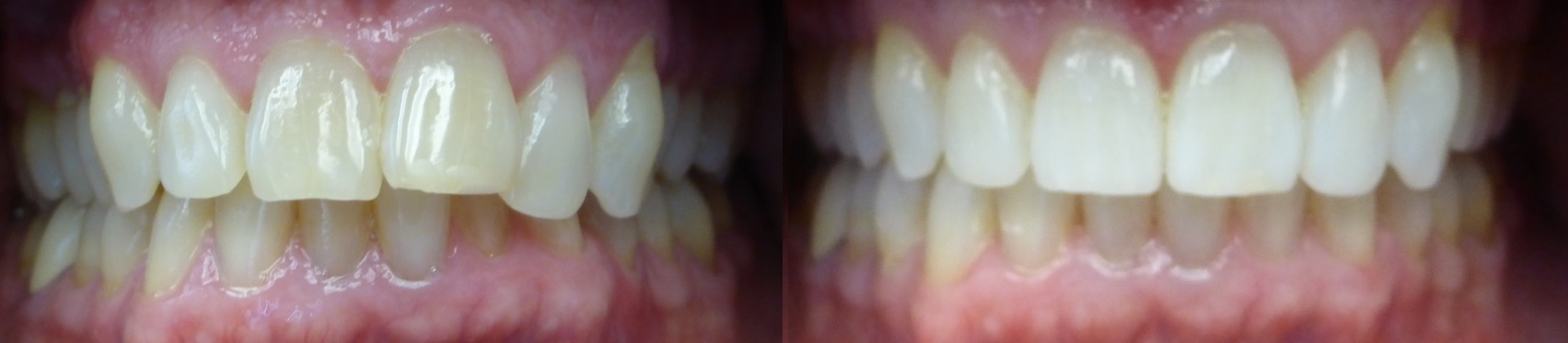 Invisalign Results 1