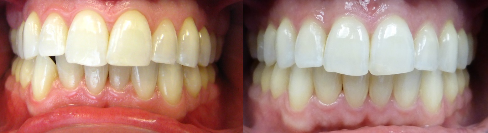 Invisalign Results 3