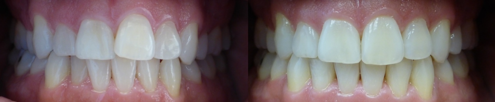 Invisalign Results 2