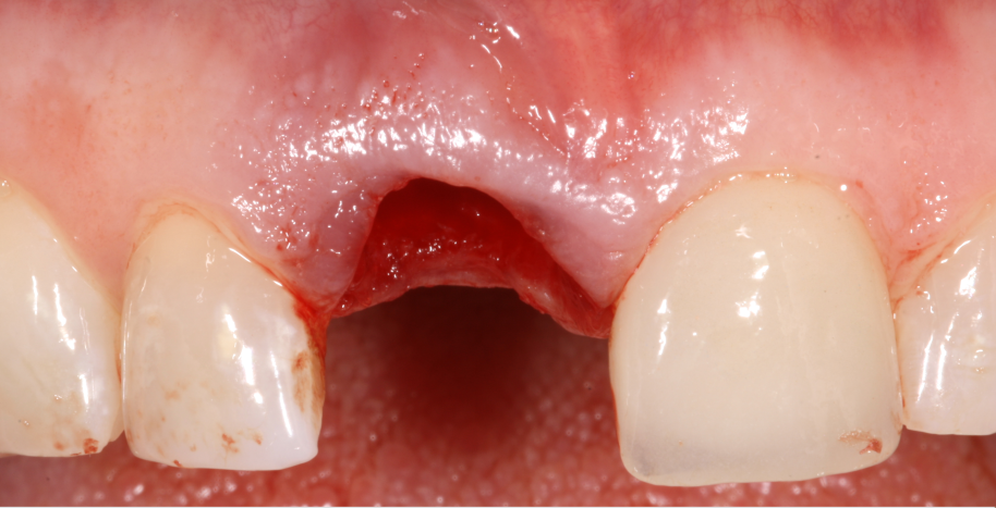 Extraction for Dental Implant RSF
