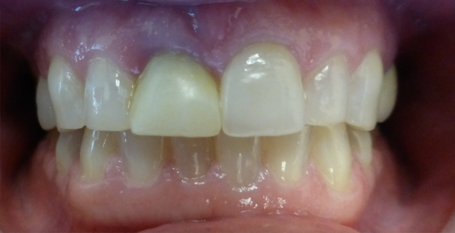 Temporary implant crown RSF