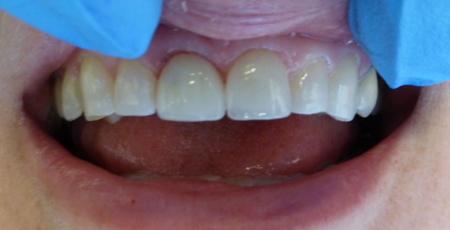 Crown placed on dental implant RSF