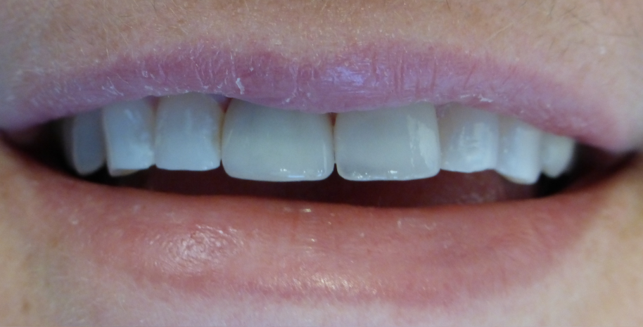 Dental implant result