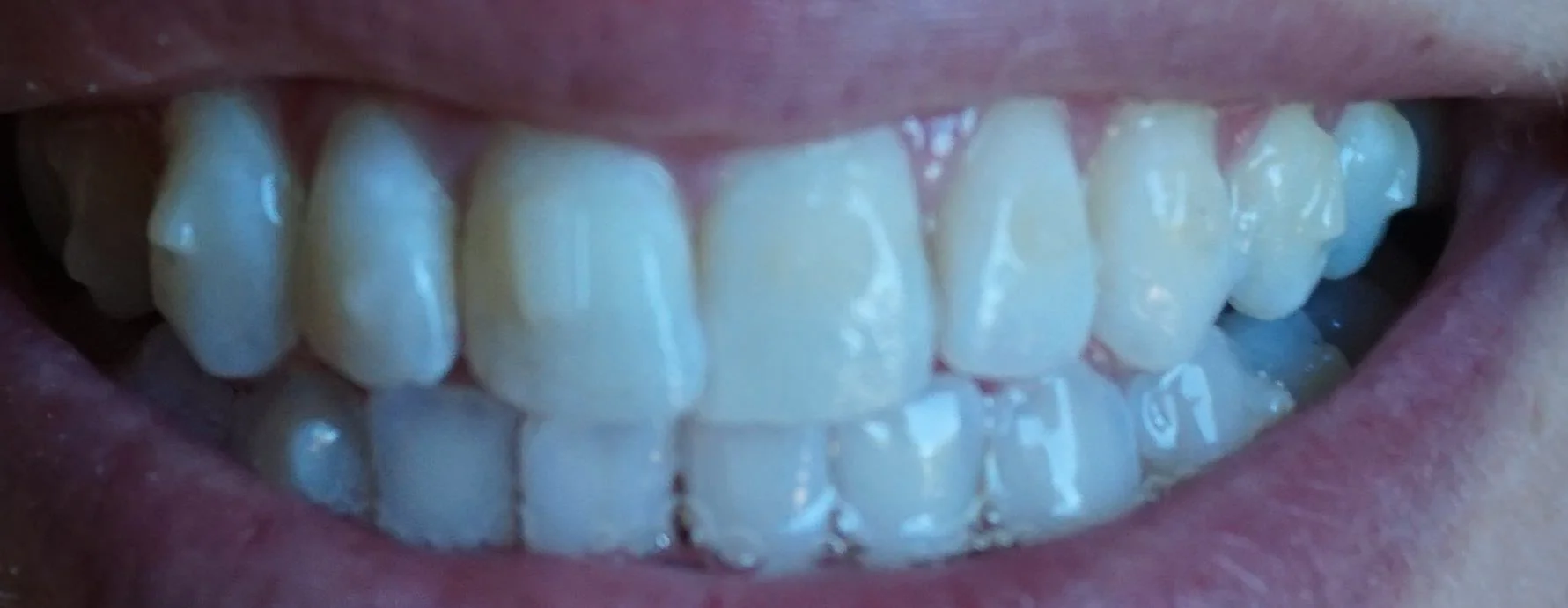 Invisalign in Rancho Santa Fe and Del Mar