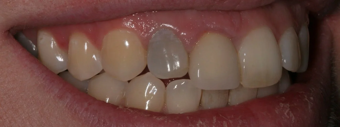 Internal Bleaching In Del Mar And Rancho Santa Fe