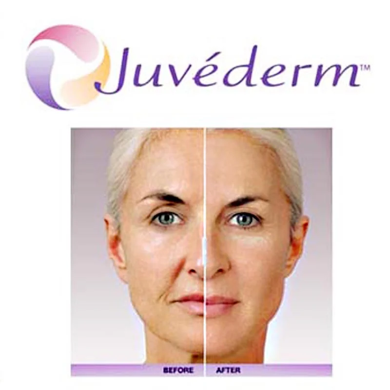 Beautiful JUVÈDERM VOLBELLA® XC Results by Dr. Sara Creekmore