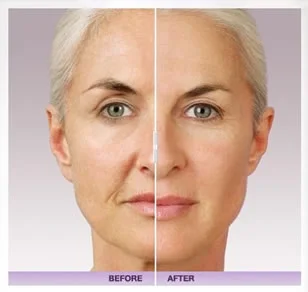 Save the Date for Our Upcoming Juvéderm® Event! 