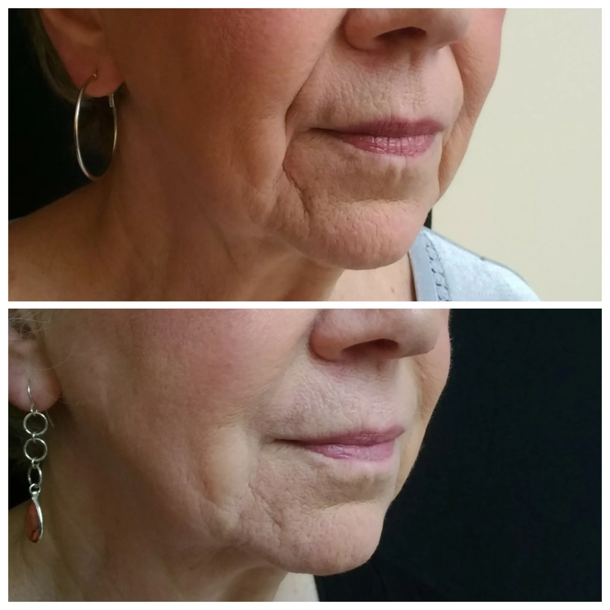 Juvéderm® Before and After Results