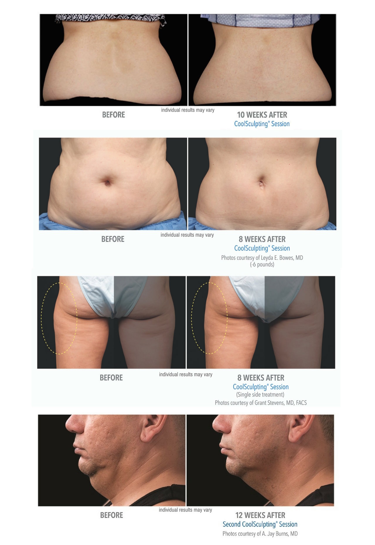 Two CoolSculpting® sessions on the flanks helped this patient achieve his  goals of reducing stubborn fat on his love handles. Individual…