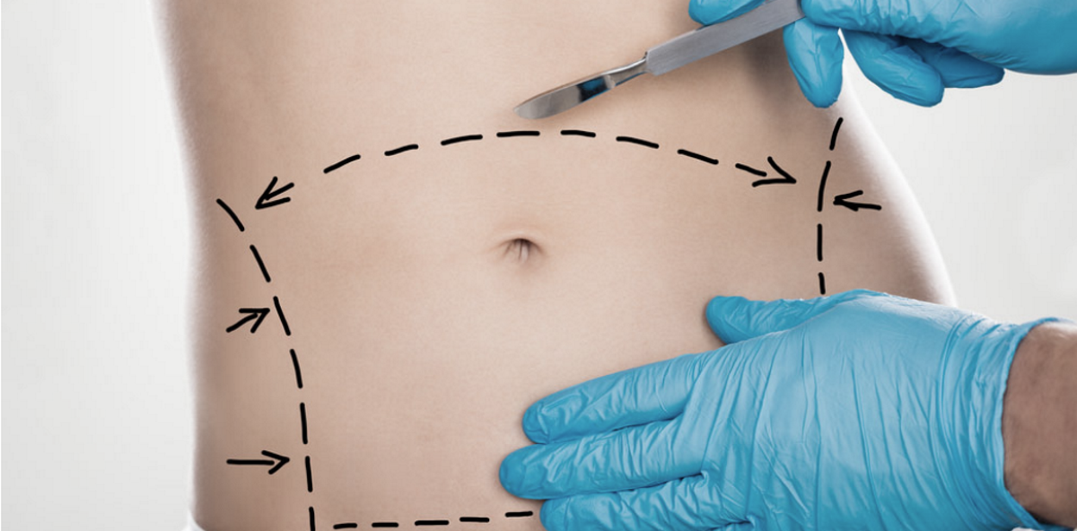 Liposuction vs CoolSculpting : Fat Reduction Options in Staten Island —  Emerson Medical