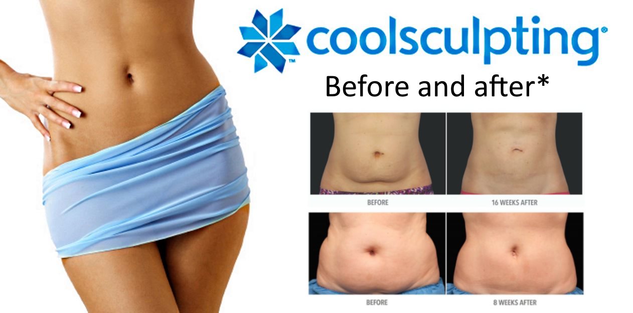 CoolSculpting for Love Handles (+ Before and After)