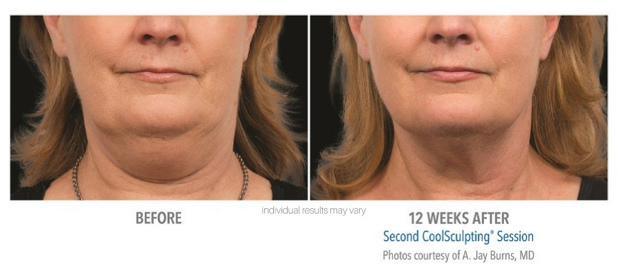 Double Chin Reduction With Coolsculpting Staten Island — Emerson Medical