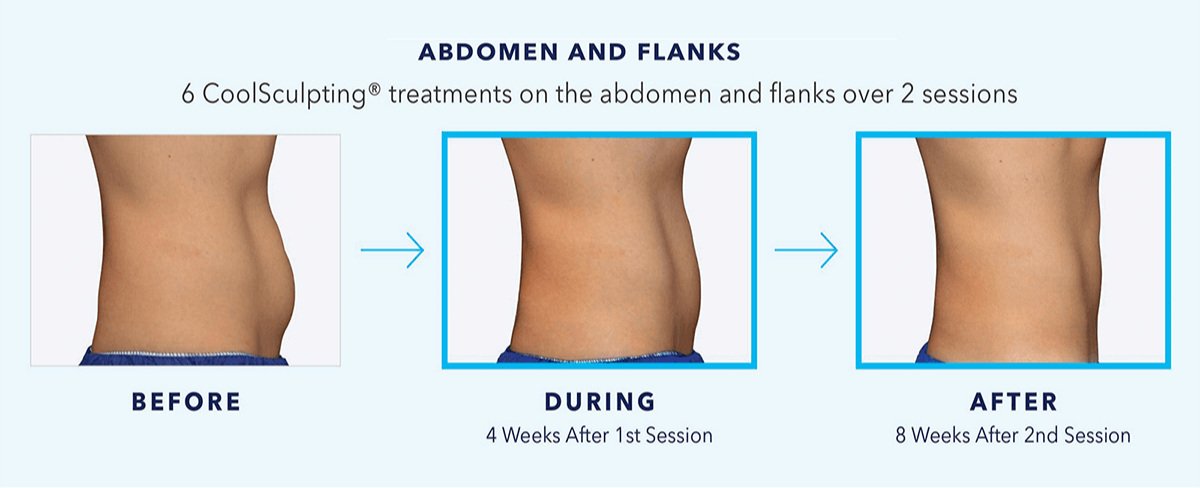 CoolSculpting® Elite Before & After Photos Patient 105, Boston, MA