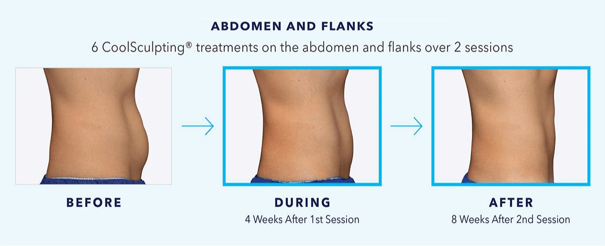 CoolSculpting® Upper Flanks