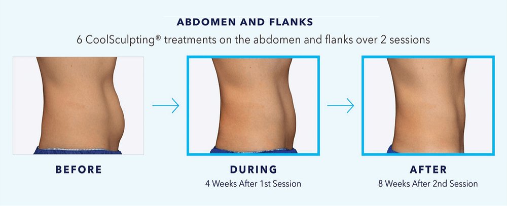 CoolSculpting and After New Treatment + Better Results — Emerson Medical