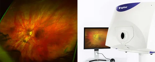 optomap_retinal_exam.jpg