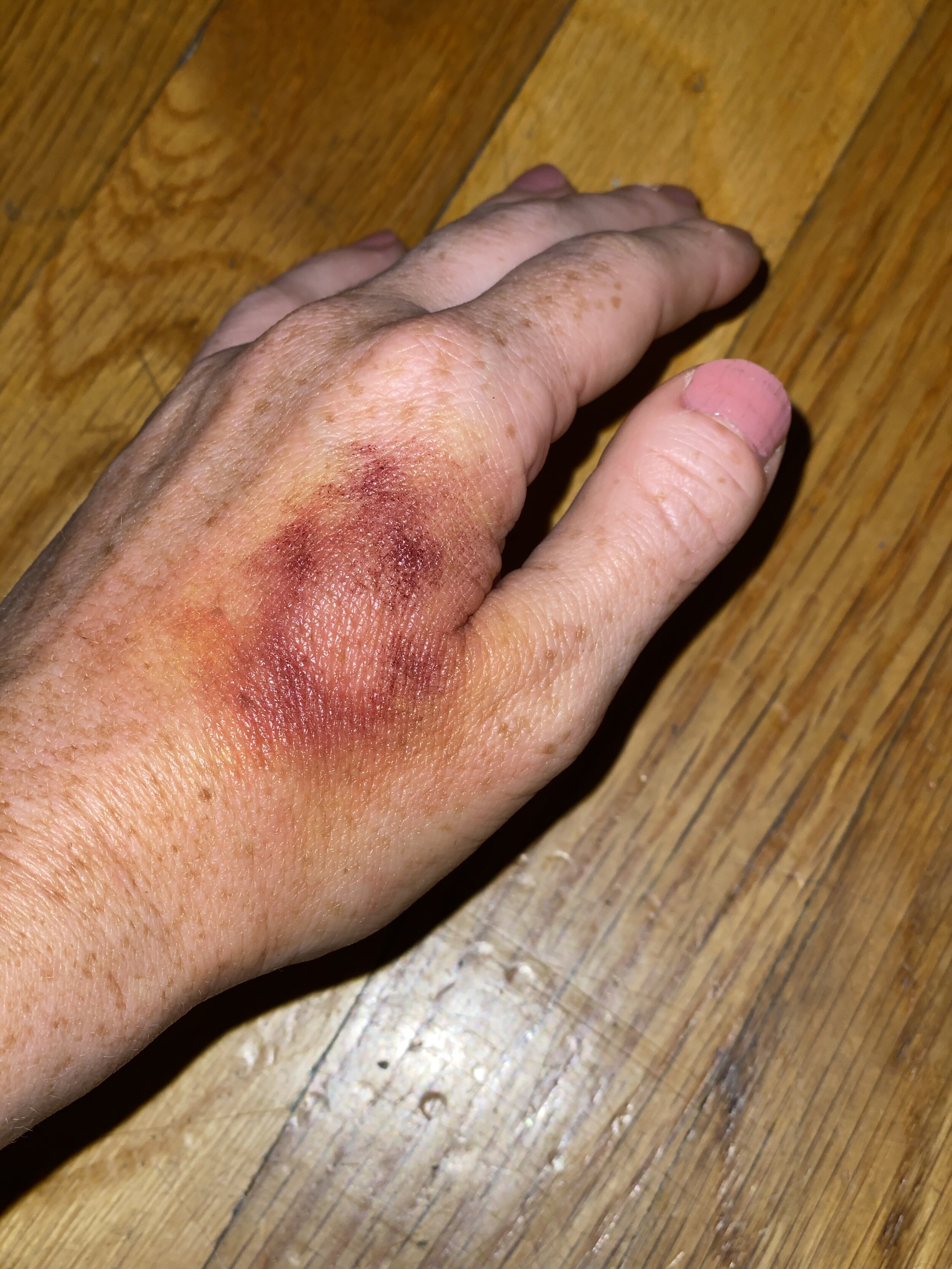 Bruise 3.jpg