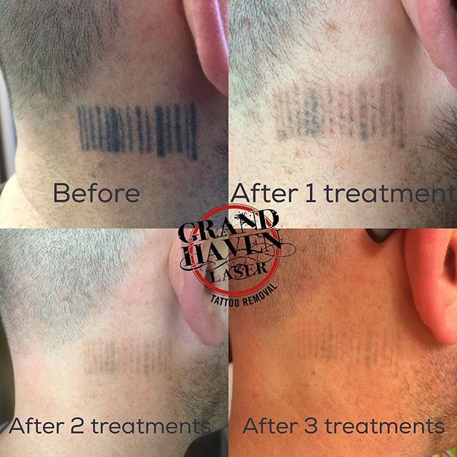 Theses progression photos were submitted by our client Jason over the weekend! Great progress after just 3 treatments! #ghlasertattooremoval #lasertattooremoval