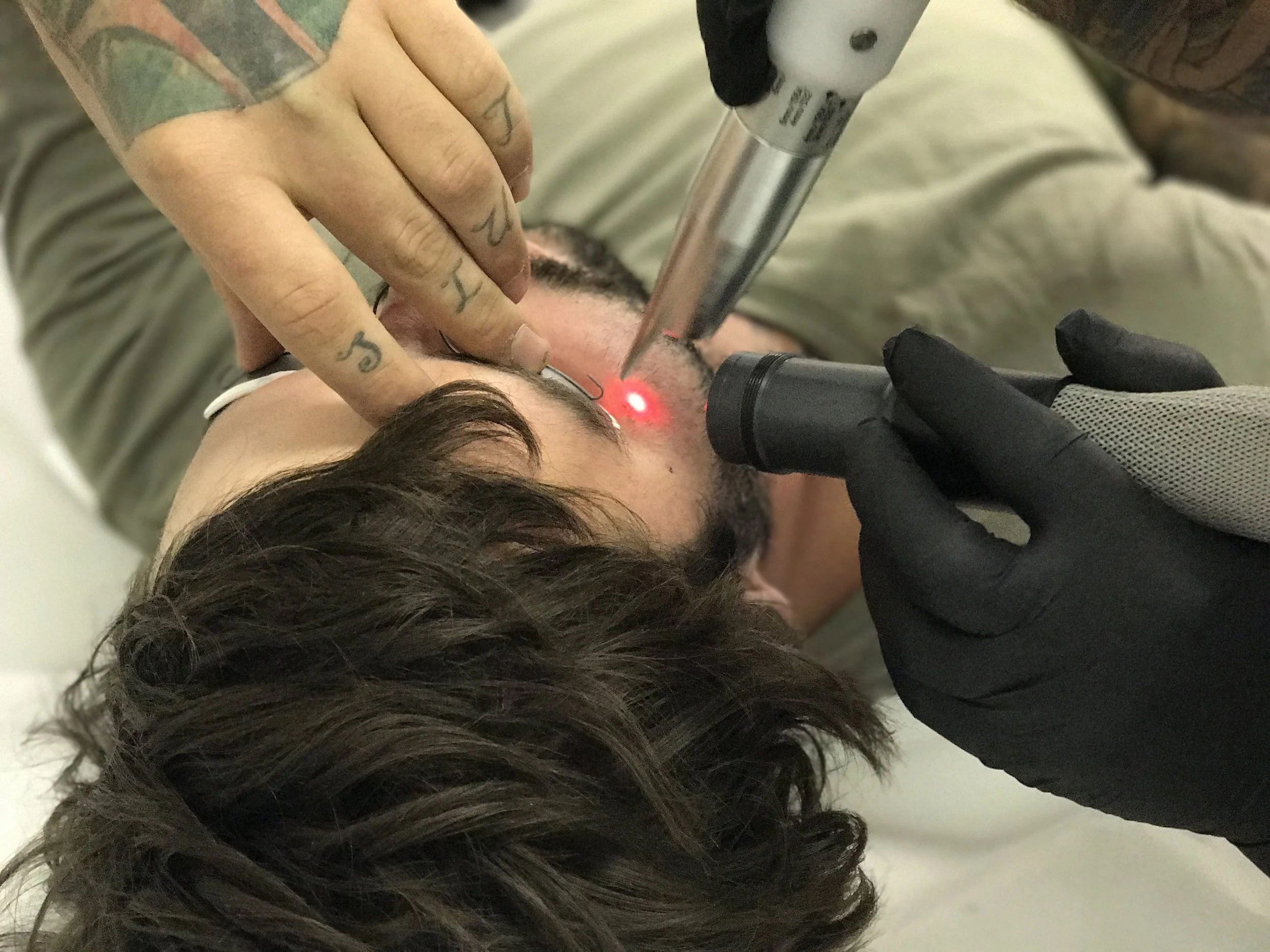 unwanted-tattoo-removal-canberra.JPG