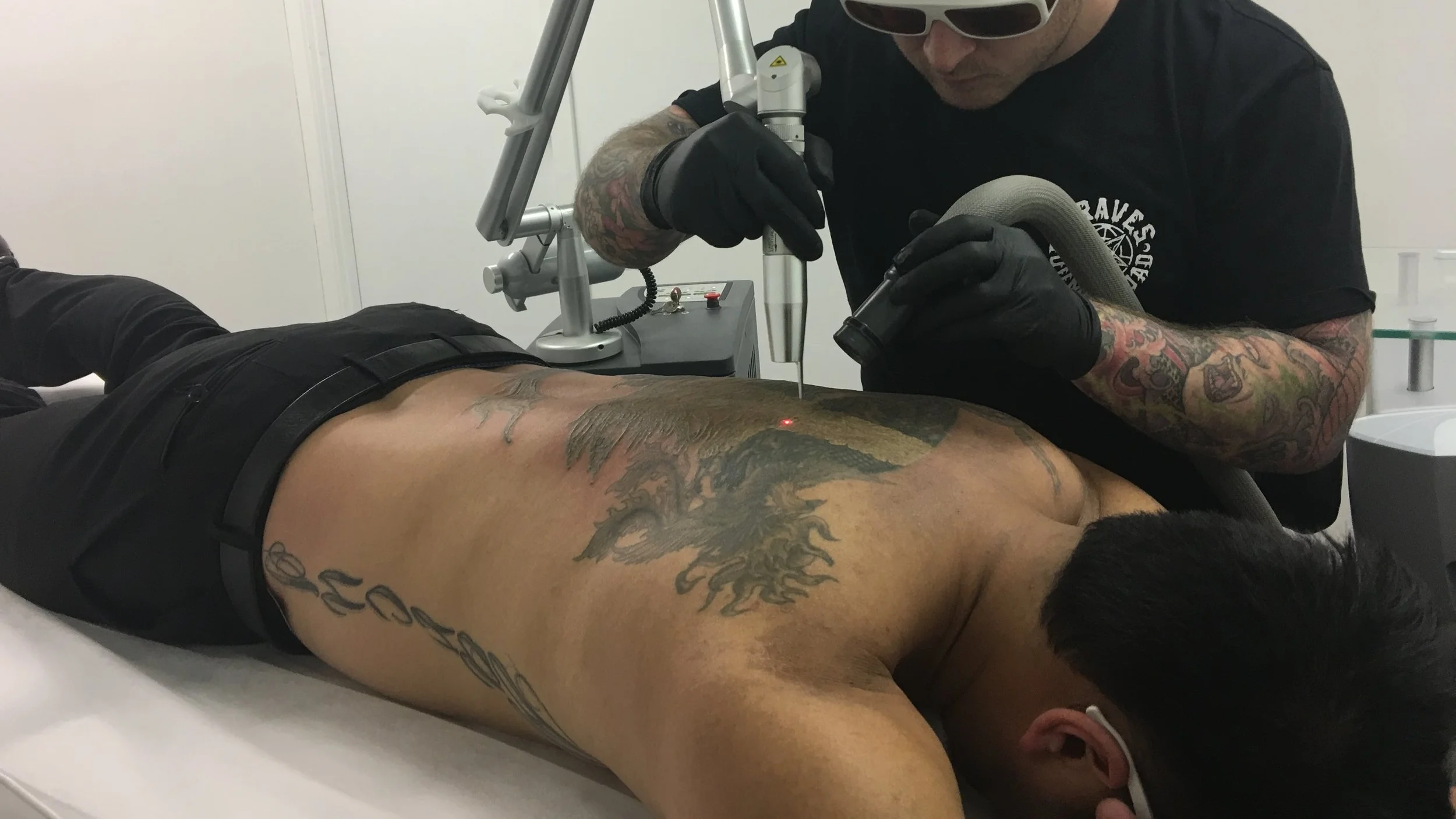 tattoo-removal-consultation-canberra.JPG