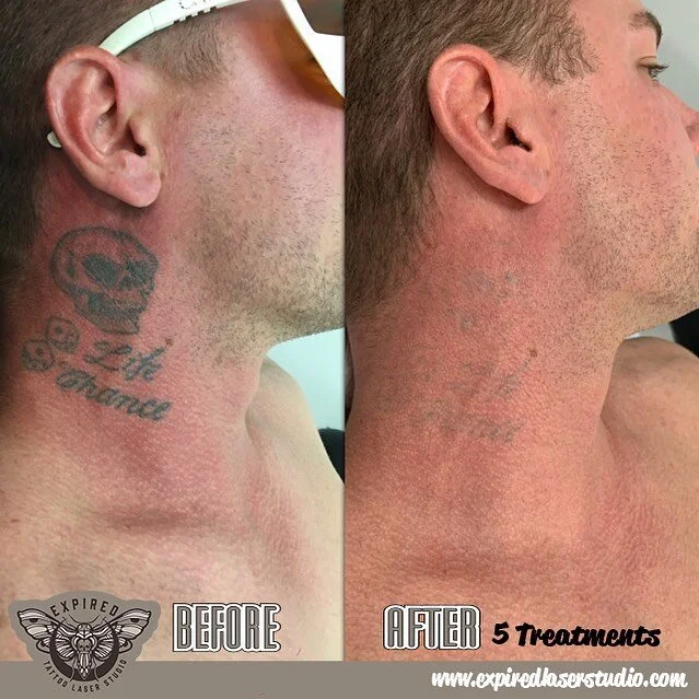 5 treatments in for bloke here, couple more to clean up the rest and he should have a brand new neck about it.
We’ve got plenty of time most days upcoming so flick us and email or give us a call and we’ll hook you right up.
🚫Please do no