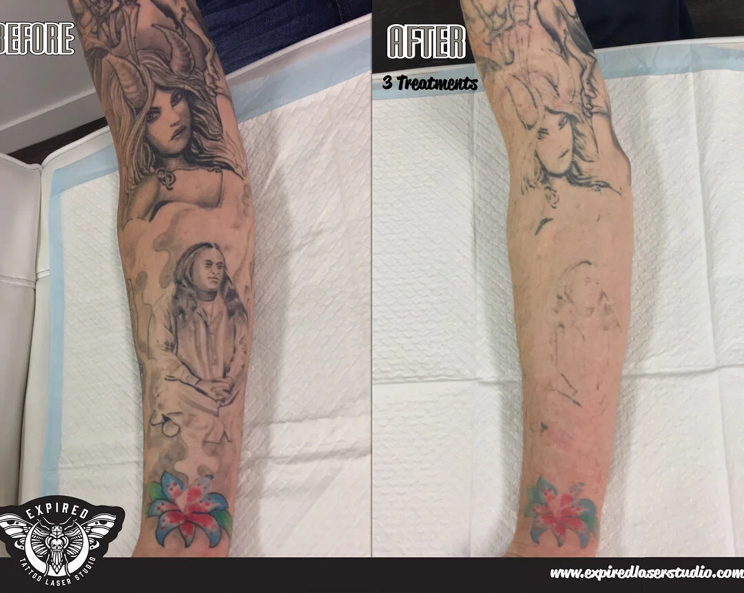 Both arms 3/4 sleeve blast in the works, 3 treatments deep for this brave fella for a future cover-up. Hopefully for him yesterday&rsquo;s 4th treatment is enough to get started 🤞🏻
SWIPE RIGHT 👉🏻
☎️ 02 6195 0873
📧 info@expiredlaserstudio.com
💻 