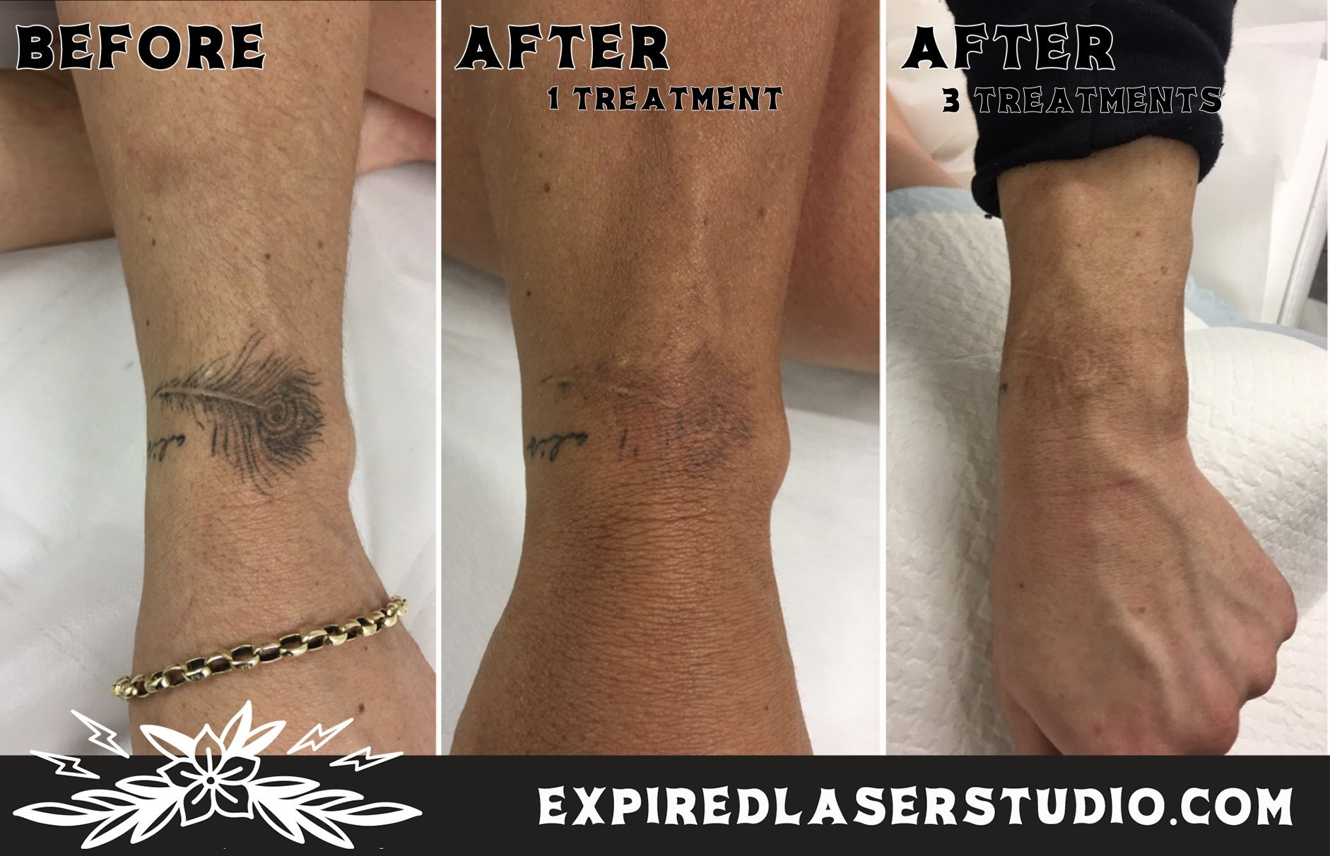 chest-tattoo-laser-removal-results.jpg
