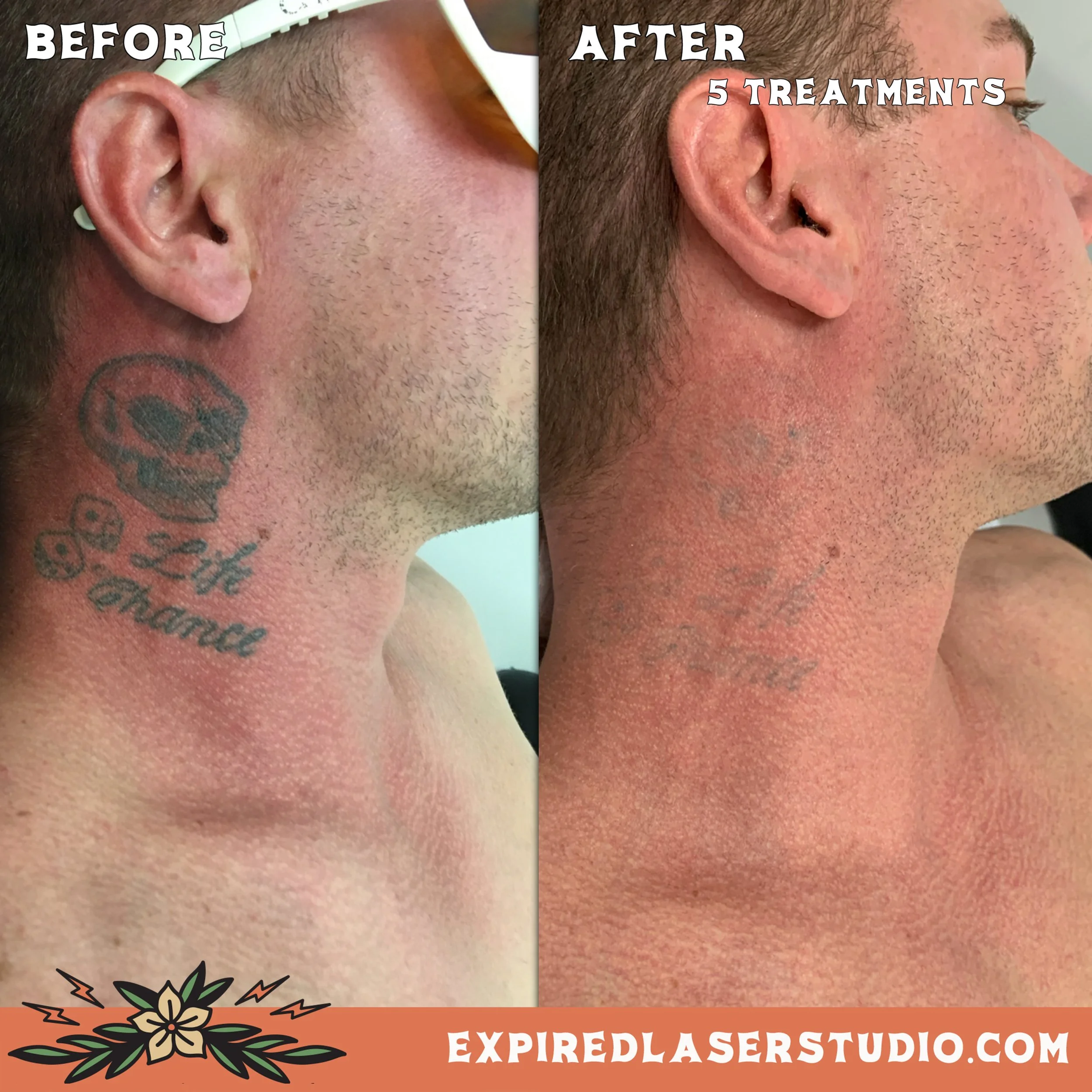 canberra-tattoo-removal-before-after-1.jpg