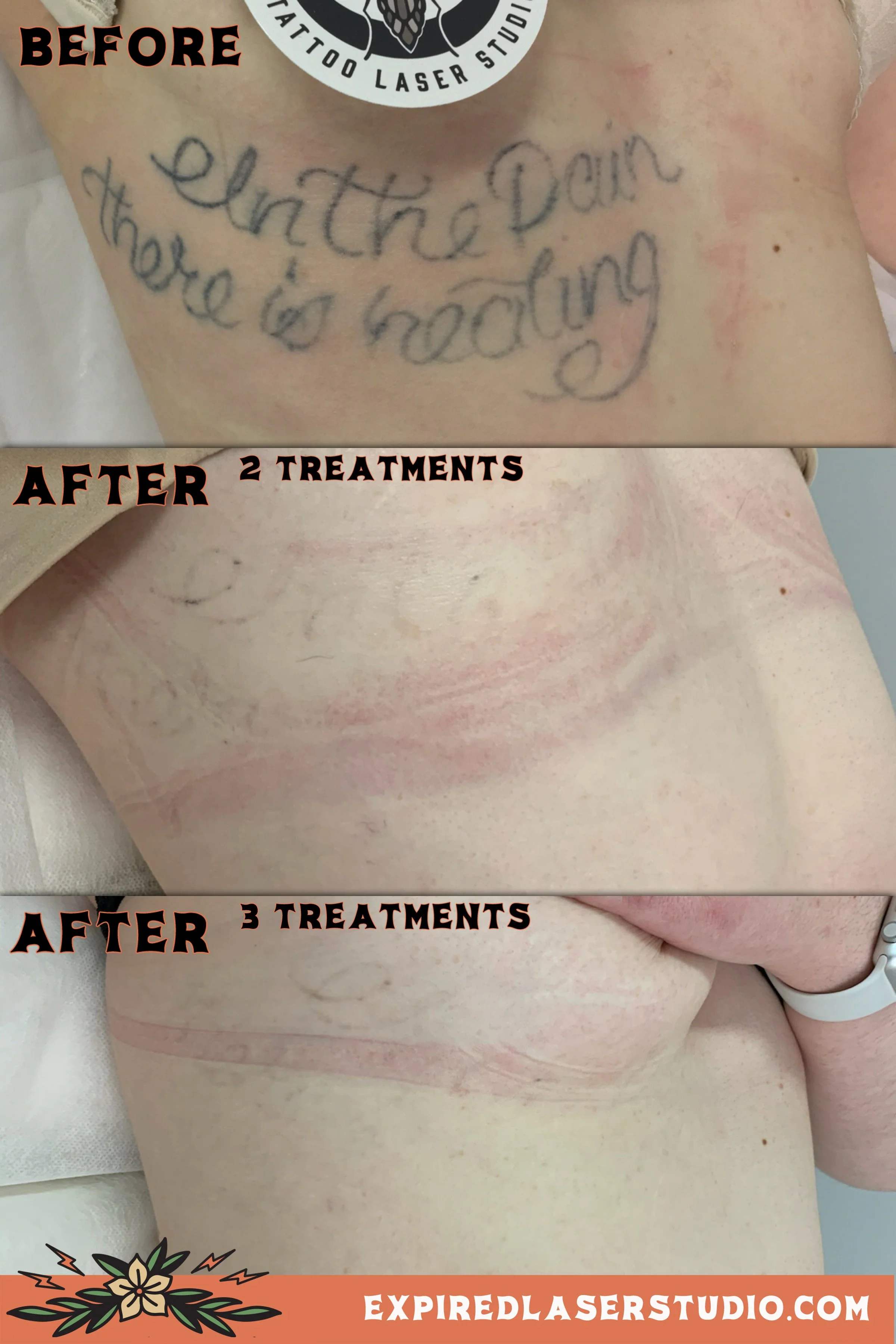fine-line-tattoo-removal-results.jpg