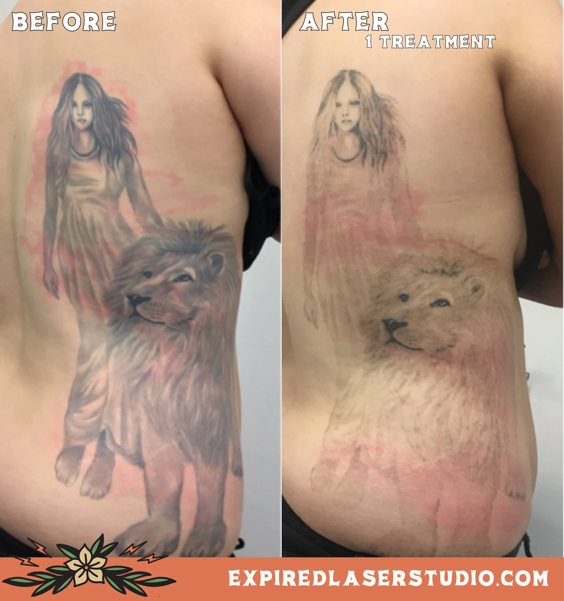 forearm-tattoo-removal-before-after.jpg